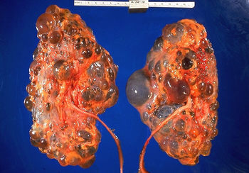 Polycystic_kidneys,_gross_pathology_20G0027_lores.jpg